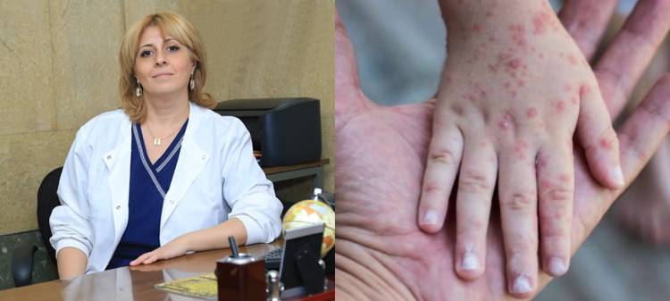 Երբ կհասնի Հայաստան Կապիկի ծաղիկ վիրուսը