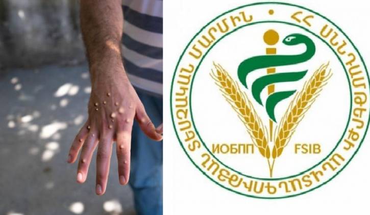 Կապիկի ծաղկի բռնկումների կանխարգելման նպատակով՝ ներմուծման և տարանցիկ փոխադրման սահմանափակում