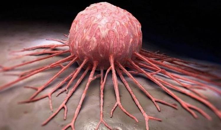 11 ախտանշան, որոնք կարող են վկայել քաղցկեղի վաղ փուլերի առկայության մասին 