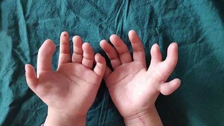 Վիրաբույժները հեռացրել են 14 մատնանի երեխայի ավելորդ մատները
