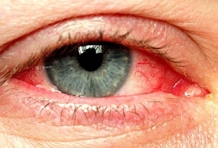 Բժիշկները բացահայտել են աչքի քաղցկեղի ախտանշանները