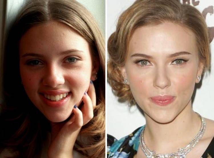 Աստղային դեմքեր. վիրահատությունից առաջ եւ հետո (լուսանկարներ)